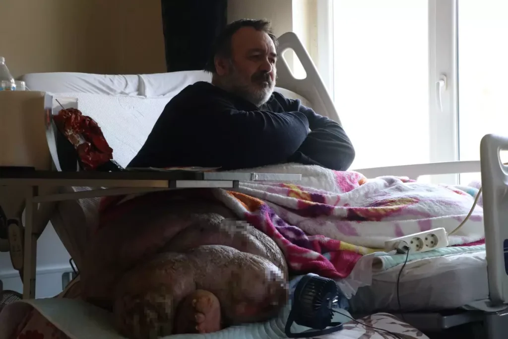 5 yıldır evden çıkamayan 300 kiloya ulaşan fil hastasının hayali; eşiyle kol kola caddede gezmek