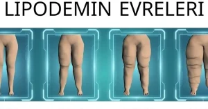 Su İçsem Yarıyor Diyorsanız Lipödem Olabilirsiniz